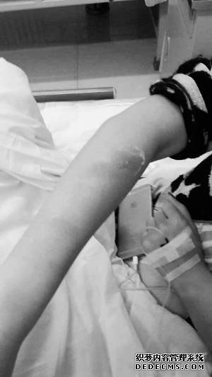 被燙傷的客人正在醫(yī)院接受治療。