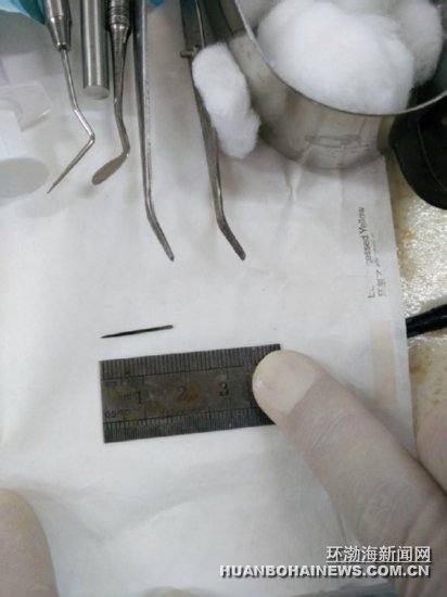 醫(yī)生取出的縫衣針。