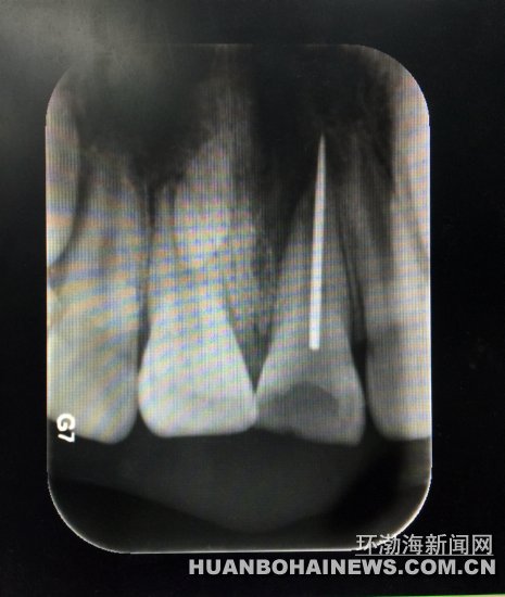X光片顯示縫衣針扎入牙齒根管。